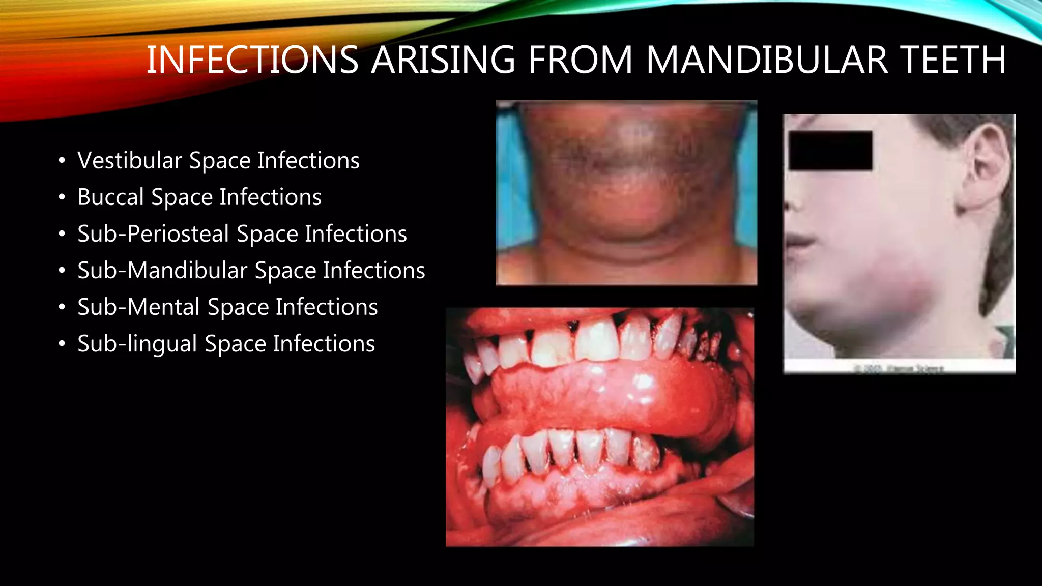 Odontogenic Infections | PPTX