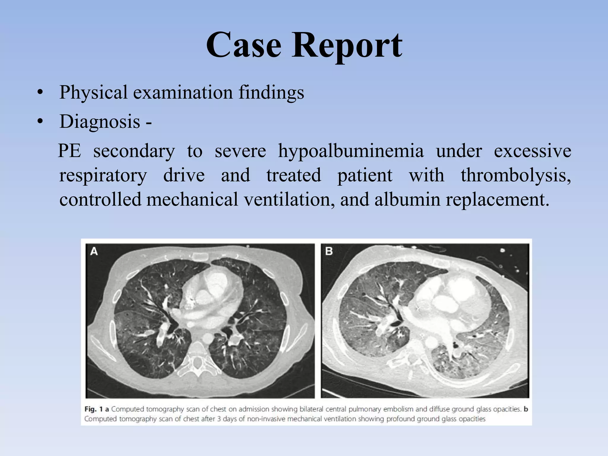 Prolonged Respiratory Failure due to Pulmonary Embolism In a young ...