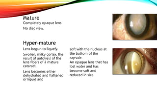 Mature
Completely opaque lens
No disc view.
Hyper-mature
Lens begun to liquefy.
Swollen, milky cortex, the
result of autolysis of the
lens fibers of a mature
cataract.
Lens becomes either
dehydrated and flattened
or liquid and
soft with the nucleus at
the bottom of the
capsule.
An opaque lens that has
lost water and has
become soft and
reduced in size.
 