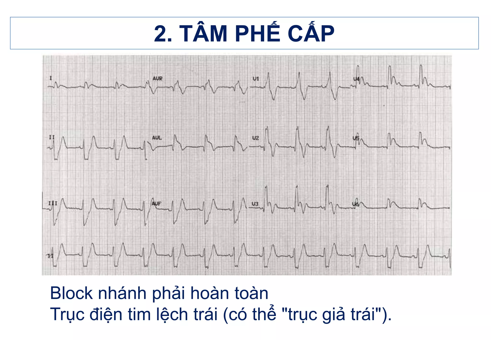 12. ECG BỆNH TÂM PHẾ.ppt