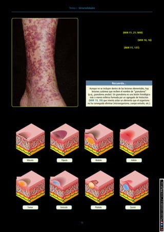Tema 1 · Generalidades
15
• Pápula: cambio de color y de tacto. Se llama placa si mide
>1 cm.
La púrpura palpable es sinónimo de vasculitis cutánea y se
manifiesta como maculopápulas purpúricas y en ocasiones
vesículas en miembros inferiores (MIR 11, 21; MIR).
• Nódulo: lesión dérmica o hipodérmica, más palpable que vi-
sible. Típico de las paniculitis (eritema nodoso) (MIR 10, 16).
• Habón: producido por edema en la dermis sin formación de
cavidad. Evanescente (<24 horas) (MIR 11, 131).
• Tumor: neoformación no inflamatoria que tiende a crecer y
persistir indefinidamente.
• Tubérculo: neoformación inflamatoria, >1 cm y deja cicatriz.
• Goma: nódulo que evoluciona en cuatro fases: crudeza, re-
blandecimiento, ulceración y reparación.
Recuerda...
Aunque no se incluyen dentro de las lesiones elementales, hay
lesiones cutáneas que reciben el nombre de “granuloma”
(p.ej., granuloma anular). Un granuloma es una lesión histológica
más o menos esférica formada por un agregado de histiocitos
(MIR 19, 39) que intenta aislar un elemento que el organismo
no ha conseguido eliminar (microorganismo, cuerpo extraño, etc.).
Figura 3. Púrpura palpable: vasculitis.
Mácula Pápula Nódulo Habón
Tumor Vesícula Pústula Quiste
Figura 4. Lesiones cutáneas elementales primarias.
 