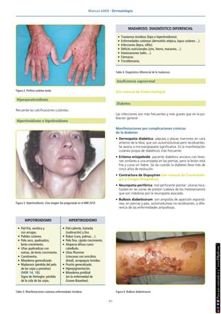 Manual AMIR · Dermatología
20
Hiperparatiroidismo
Recuerda las calcificaciones cutáneas.
Hipertiroidismo e hipotiroidismo
Insuficiencia suprarrenal
(Ver manual de Endocrinología)
Diabetes
Las infecciones son más frecuentes y más graves que en la po-
blación general.
Manifestaciones por complicaciones crónicas
de la diabetes
• Dermopatía diabética: pápulas y placas marrones en cara
anterior de la tibia, que son autoinvolutivas pero recidivantes.
Se asocia a microangiopatía significativa. Es la manifestación
cutánea propia de diabéticos más frecuente.
• Eritema erisipeloide: paciente diabético anciano con lesio-
nes similares a una erisipela en las piernas, pero la lesión está
fría y cursa sin fiebre. Se da cuando la diabetes lleva más de
cinco años de evolución.
• Contractura de Dupuytren (ver manual de Traumatolo-
gía y Cirugía Ortopédica).
• Neuropatía periférica: mal perforante plantar: úlceras loca-
lizadas en las zonas de presión (cabeza de los metatarsianos)
que son indoloras por la neuropatía asociada.
• Bullosis diabeticorum: son ampollas de aparición espontá-
nea, en piernas y pies, autoinvolutivas no recidivantes, a dife-
rencia de las enfermedades ampollosas.
Figura 3. Hipertiroidismo. Esta imagen fue preguntada en el MIR 2010.
Tabla 3. Manifestaciones cutáneas enfermedades tiroideas.
HIPOTIROIDISMO HIPERTIROIDISMO
• Piel fría, xerótica y
con arrugas.
• Palidez cutánea.
• Pelo seco, quebradizo,
lento crecimiento.
• Uñas quebradizas con
estrías, de lento crecimiento.
• Carotinemia.
• Mixedema generalizado.
• Madarosis (pérdida del pelo
de las cejas y pestañas)
(MIR 14, 18).
Signo de Hertoghe: pérdida
de la cola de las cejas.
• Piel caliente, húmeda
(sudoración) y lisa.
• Rubor (cara, palmas…).
• Pelo fino, rápido crecimiento.
• Alopecia difusa cuero
cabelludo.
• Uñas Plummer
(cóncavas con onicólisis
distal), acropaquia tiroidea.
• Prurito generalizado.
• Hiperpigmentación.
• Mixedema pretibial
(en la enfermedad de
Graves-Basedow).
Tabla 4. Diagnóstico diferencial de la madarosis.
MADAROSIS: DIAGNÓSTICO DIFERENCIAL
• Trastornos tiroideos (hipo e hipertiroidismo).
• Enfermedades cutáneas (dermatitis atópica, lupus cutáneo…).
• Infecciones (lepra, sífilis).
• Déficits nutricionales (zinc, hierro, marasmo…).
• Intoxicaciones (talio…).
• Fármacos.
• Tricotilomanía.
Figura 4. Bullosis diabeticorum.
Figura 2. Porfiria cutánea tarda.
 