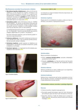Tema 2 · Manifestaciones cutáneas de las enfermedades sistémicas
21
Manifestaciones asociadas frecuentemente a diabetes
• Necrobiosis lipoídica diabeticorum: afecta al 0,3% de los
diabéticos. Es más frecuente en mujeres. Consiste en una
placa eritemato-amarillenta recorrida en la superficie por
telangiectasias. Es debida a la atrofia y puede ulcerarse. Su
localización más típica es la pretibial. En casi la mitad de los
pacientes aparecen en ausencia de diabetes. Se tratan con
corticoides tópicos con escaso éxito (MIR).
• Granuloma anular: lesión eritematosa anular en “DORSO
DE LAS MANOS”. Se trata de una dermatosis inflamatoria de
causa mayormente desconocida, aunque en algunas ocasio-
nes puede asociarse a diabetes y a enfermedades tiroideas
(que hay que descartar), pero sin clara evidencia.
La histología del granuloma anular es un agregado de histioci-
tos “en empalizada” (reacción granulomatosa) que presenta
colágeno degenerado en su interior (“necrobiosis”).
No existe tratamiento específico, pero las lesiones pueden in-
volucionar espontáneamente.
• Esclerema adultorum: induración cutánea que comienza en
caras laterales del cuello y que se extiende periféricamente.
No está asociado siempre a diabetes.
• Xantomas eruptivos: pueden aparecer en diabéticos con
hiperlipidemia. Las lesiones se resuelven lentamente cuando
la diabetes es controlada.
• Acantosis nigricans: en el apartado de enfermedades para-
neoplásicas está explicada (MIR).
Xantomatosis (MIR 12, 89)
Los histiocitos se cargan de lípidos (histiocitos espumosos), de-
positándose en la piel.
Xantomas eruptivos
Pápulas de 0,5 cm de diámetro en glúteo y codos con halo eri-
tematoso. Secundarios a hiperquilomicronemia.
Xantoma plano
Mácula amarillenta, localizada en:
• Palmas: xantoma estriado palmar, asociado a disbetalipo-
proteinemia familiar tipo III.
• Párpados: xantelasma, es el tipo de xantoma más frecuente
y normalmente no hay alteración del metabolismo lipídico
asociado.
Xantoma tuberoso
Nódulos amarillentos en codos y rodillas que no son específicos
de una dislipoproteinemia en concreto.
Xantoma tendinoso
Nódulos duros cubiertos por piel normal, localizados en el ten-
dón de Aquiles y rotuliano. Se desplazan fácilmente. Asociados
a hipercolesterolemia familiar tipo Ila.
Enfermedades cutáneas asociadas a patología digestiva
Páncreas
• Eritema necrolítico migratorio (glucagonoma).
• Pancreatitis aguda hemorrágica: signo de Cullen (hematoma
periumbilical) y signo de Grey-Turner (hematoma en flancos).
• Paniculitis: lesiones a modo de nódulos que se ulceran en
MMII y abdomen. Recuerda las células fantasma del infiltrado
histológico (MIR).
Figura 5. Necrobiosis lipoídica.
Figura 6. Granuloma anular.
Figura 7. Xantomas eruptivos.
 