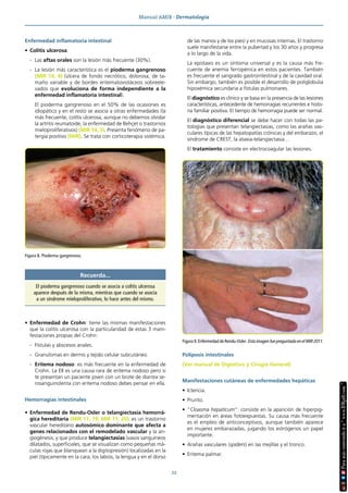 Manual AMIR · Dermatología
22
Enfermedad inflamatoria intestinal
• Colitis ulcerosa.
- Las aftas orales son la lesión más frecuente (30%).
- La lesión más característica es el pioderma gangrenoso
(MIR 14, 4) (úlcera de fondo necrótico, dolorosa, de ta-
maño variable y de bordes eritematovioláceos sobreele-
vados que evoluciona de forma independiente a la
enfermedad inflamatoria intestinal).
El pioderma gangrenoso en el 50% de las ocasiones es
idiopático y en el resto se asocia a otras enfermedades (la
más frecuente, colitis ulcerosa, aunque no debemos olvidar
la artritis reumatoide, la enfermedad de Behçet o trastornos
mieloproliferativos) (MIR 14, 3). Presenta fenómeno de pa-
tergia positivo (MIR). Se trata con corticoterapia sistémica.
• Enfermedad de Crohn: tiene las mismas manifestaciones
que la colitis ulcerosa con la particularidad de estas 3 mani-
festaciones propias del Crohn:
- Fístulas y abscesos anales.
- Granulomas en dermis y tejido celular subcutáneo.
- Eritema nodoso: es más frecuente en la enfermedad de
Crohn. La EII es una causa rara de eritema nodoso pero si
te presentan un paciente joven con un brote de diarrea se-
rosanguinolenta con eritema nodoso debes pensar en ella.
Hemorragias intestinales
• Enfermedad de Rendu-Osler o telangiectasia hemorrá-
gica hereditaria (MIR 11, 19; MIR 11, 20): es un trastorno
vascular hereditario autosómico dominante que afecta a
genes relacionados con el remodelado vascular y la an-
giogénesis, y que produce telangiectasias (vasos sanguíneos
dilatados, superficiales, que se visualizan como pequeñas má-
culas rojas que blanquean a la digitopresión) localizadas en la
piel (típicamente en la cara, los labios, la lengua y en el dorso
de las manos y de los pies) y en mucosas internas. El trastorno
suele manifestarse entre la pubertad y los 30 años y progresa
a lo largo de la vida.
La epistaxis es un síntoma universal y es la causa más fre-
cuente de anemia ferropénica en estos pacientes. También
es frecuente el sangrado gastrointestinal y de la cavidad oral.
Sin embargo, también es posible el desarrollo de poliglobulia
hipoxémica secundaria a fístulas pulmonares.
El diagnóstico es clínico y se basa en la presencia de las lesiones
características, antecedente de hemorragias recurrentes e histo-
ria familiar positiva. El tiempo de hemorragia puede ser normal.
El diagnóstico diferencial se debe hacer con todas las pa-
tologías que presentan telangiectasias, como las arañas vas-
culares típicas de las hepatopatías crónicas y del embarazo, el
síndrome de CREST, la ataxia-telangiectasia…
El tratamiento consiste en electrocoagular las lesiones.
Poliposis intestinales
(Ver manual de Digestivo y Cirugía General)
Manifestaciones cutáneas de enfermedades hepáticas
• Ictericia.
• Prurito.
• “Cloasma hepaticum”: consiste en la aparición de hiperpig-
mentación en áreas fotoexpuestas. Su causa más frecuente
es el empleo de anticonceptivos, aunque también aparece
en mujeres embarazadas, jugando los estrógenos un papel
importante.
• Arañas vasculares (spiders) en las mejillas y el tronco.
• Eritema palmar.
Figura 8. Pioderma gangrenoso.
Recuerda...
El pioderma gangrenoso cuando se asocia a colitis ulcerosa
aparece después de la misma, mientras que cuando se asocia
a un síndrome mieloproliferativo, lo hace antes del mismo.
Figura 9. Enfermedad de Rendu-Osler. Esta imagen fue preguntada en el MIR 2011.
 