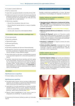 Tema 2 · Manifestaciones cutáneas de las enfermedades sistémicas
23
• Circulación colateral abdominal.
• Porfiria cutánea tarda.
• Liquen plano, que aparece asociado a cirrosis biliar primaria y VHC.
• Síndrome de Gianotti-Crosti (brote de lesiones papulosas de
localización peribucal y en manos y pies en niño pequeño):
es consecuencia de una primoinfección por VHB, pero otros
virus pueden dar un cuadro idéntico.
• Alteraciones ungueales.
- Uñas de Terry (uña blanca), típico de cirrosis.
- Uñas de Muercke (bandas blancas), se asocia a hipoalbu-
minemia.
- Uñas con surco de Beau.
- Lúnulas azules: típicas de la enfermedad de Wilson.
Enfermedades cutáneas asociadas a patología renal
• Prurito generalizado.
• Equimosis y petequias.
• Pigmentación pajiza.
• Dermatosis perforantes.
• Escarcha urémica.
• Dermatosis ampollosas por fármacos fotosensibilizantes.
• Pseudoporfiria: presentan las lesiones típicas de la porfiria en
las manos consistentes en fragilidad cutánea, pero las porfiri-
nas son normales. Se trata mediante sangrías.
• Uñas mitad-mitad: las uñas tienen una banda blanca proximal
y una rojiza distal. Aparecen en un tercio de los pacientes con
uremia.
• Calcifilaxis: desarrollo de úlceras necróticas de forma aguda
en las extremidades inferiores en la insuficiencia renal cró-
nica. Se originan por calcificación de los vasos de pequeño
y mediano calibre. También aparece en pacientes diabéticos
evolucionados y en hiperparatiroidismo. El tratamiento se
realiza desbridando las úlceras, paratiroidectomía en algunos
casos y corticoterapia oral.
Sarcoidosis
Manifestaciones no específicas
• Eritema nodoso, la más frecuente.
Manifestaciones específicas
• Sarcoidosis sobre cicatrices: esto es muy típico y debe hacerte
sospechar una sarcoidosis un paciente que desarrolla lesiones
sobre cicatrices que tenía desde hacía varios años.
• Lupus pernio: es la más característica; se trata de una placa
indurada violácea crónica en la nariz. Aparece más frecuen-
temente en mujeres con sarcoidosis persistente y afectación
pulmonar, uveítis crónica y lesiones óseas (MIR).
• Pápulas y placas sobreelevadas en cara, tronco y que a la
vitropresión son amarillentas “en jalea de manzana”.
El tratamiento de las lesiones cutáneas se realiza con corticoides
tópicos.
2.2. Manifestaciones paraneoplásicas
Preceden o evolucionan paralelamente a un tumor. No tienen
características clinicohistológicas de malignidad. Se clasifican en:
Cambios cutáneos por productos metabólicos
producidos por la neoplasia
• Hiperpigmentación addisoniana y síndrome de Cushing:
por MSH o ACTH, en neoplasias pulmonares de células de
avena, páncreas, tiroides y neuroblastomas. Encías y palmas
de manos pigmentadas.
• Síndrome carcinoide (ver manual de Endocrinología).
• Melanosis grisácea dérmica con melanuria: metástasis de
melanoma.
• Síndrome de Raynaud: aparece con frecuencia cuando
existe hiperviscosidad sanguínea; por ejemplo, en el mieloma
múltiple. Pero no siempre es manifestación paraneoplásica,
también puede ser idiopático o formar parte de la escleroder-
mia sistémica o la enfermedad de CREST.
• Hirsutismo y virilización: en algunos tumores de ovario,
suprarrenales y bronquios.
• Eritema necrolítico migratorio: en glucagonoma. Lesiones
eritematosas de bordes circinados localizadas en áreas “pe-
riorificiales” y abdomen. Además pérdida de peso, “glositis y
estomatitis” junto a hiperglucemia.
Cambios cutáneos que se asocian
con frecuencia a neoplasias
• Acantosis nigricans maligna: piel marrón aterciopelada en
axilas y área posterior del cuello. Hay dos datos que permiten
diferenciar la forma benigna de la maligna: la afectación mu-
cosa y la queratodermia palmoplantar son indicadoras de ma-
lignidad (MIR). Es típica del adenocarcinoma gástrico. Las
formas benignas son la hereditaria y la pseudoacantosis (pa-
cientes con resistencia insulínica) en obesos, diabéticos, acro-
megalia, Cushing, ovarios poliquísticos y pacientes tratados
con ácido nicotínico o estrógenos.
Figura 10. Acantosis nigricans.
 