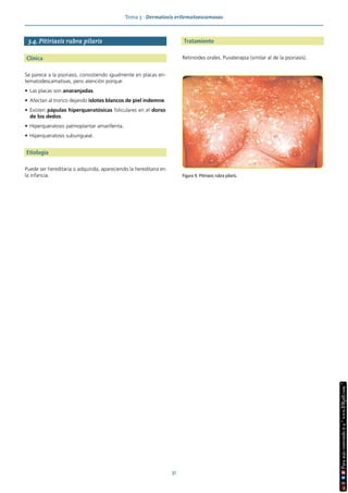 Tema 3 · Dermatosis eritematoescamosas
31
3.4. Pitiriasis rubra pilaris
Clínica
Se parece a la psoriasis, consistiendo igualmente en placas eri-
tematodescamativas, pero atención porque:
• Las placas son anaranjadas.
• Afectan al tronco dejando islotes blancos de piel indemne.
• Existen pápulas hiperqueratósicas foliculares en el dorso
de los dedos.
• Hiperqueratosis palmoplantar amarillenta.
• Hiperqueratosis subungueal.
Etiología
Puede ser hereditaria o adquirida, apareciendo la hereditaria en
la infancia.
Tratamiento
Retinoides orales. Puvaterapia (similar al de la psoriasis).
Figura 9. Pitiriasis rubra pilaris.
 