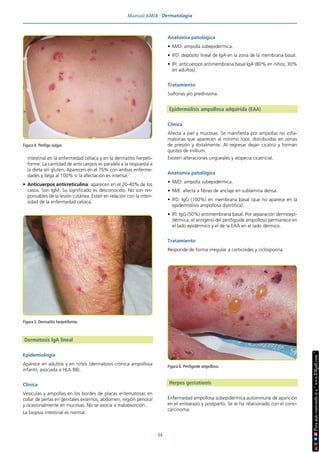 Manual AMIR · Dermatología
34
intestinal en la enfermedad celíaca y en la dermatitis herpeti-
forme. La cantidad de anticuerpos es paralela a la respuesta a
la dieta sin gluten. Aparecen en el 75% con ambas enferme-
dades y llega al 100% si la afectación es intensa.
• Anticuerpos antirreticulina: aparecen en el 20-40% de los
casos. Son IgM. Su significado es desconocido. No son res-
ponsables de la lesión cutánea. Están en relación con la inten-
sidad de la enfermedad celíaca.
Dermatosis IgA lineal
Epidemiología
Aparece en adultos y en niños (dermatosis crónica ampollosa
infantil, asociada a HLA B8).
Clínica
Vesículas y ampollas en los bordes de placas eritematosas en
collar de perlas en genitales externos, abdomen, región perioral
y ocasionalmente en mucosas. No se asocia a malabsorción.
La biopsia intestinal es normal.
Anatomía patológica
• M/O: ampolla subepidérmica.
• IFD: depósito lineal de IgA en la zona de la membrana basal.
• IFI: anticuerpos antimembrana basal IgA (80% en niños; 30%
en adultos).
Tratamiento
Sulfonas y/o prednisona.
Epidermólisis ampollosa adquirida (EAA)
Clínica
Afecta a piel y mucosas. Se manifiesta por ampollas no infla-
matorias que aparecen al mínimo roce, distribuidas en zonas
de presión y distalmente. Al regresar dejan cicatriz y forman
quistes de millium.
Existen alteraciones ungueales y alopecia cicatricial.
Anatomía patológica
• M/O: ampolla subepidérmica.
• M/E: afecta a fibras de anclaje en sublámina densa.
• IFD: IgG (100%) en membrana basal (que no aparece en la
epidermólisis ampollosa distrófica).
• IFI: IgG (50%) antimembrana basal. Por separación dermoepi-
dérmica, el antígeno del penfigoide ampolloso permanece en
el lado epidérmico y el de la EAA en el lado dérmico.
Tratamiento
Responde de forma irregular a corticoides y ciclosporina.
Herpes gestationis
Enfermedad ampollosa subepidérmica autoinmune de aparición
en el embarazo y postparto. Se le ha relacionado con el corio-
carcinoma.
Figura 5. Dermatitis herpetiforme.
Figura 6. Penfigoide ampolloso.
Figura 4. Pénfigo vulgar.
 