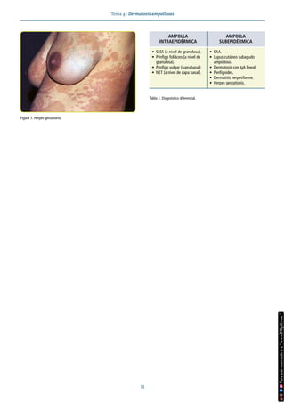 Tema 4 · Dermatosis ampollosas
35
Figura 7. Herpes gestationis.
Tabla 2. Diagnóstico diferencial.
AMPOLLA
INTRAEPIDÉRMICA
AMPOLLA
SUBEPIDÉRMICA
• SSSS (a nivel de granulosa).
• Pénfigo foliáceo (a nivel de
granulosa).
• Pénfigo vulgar (suprabasal).
• NET (a nivel de capa basal).
• EAA.
• Lupus cutáneo subagudo
ampolloso.
• Dermatosis con IgA lineal.
• Penfigoides.
• Dermatitis herpetiforme.
• Herpes gestationis.
 