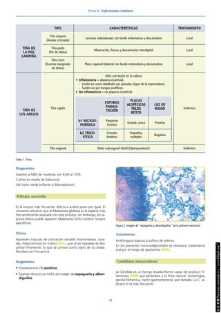 Tema 6 · Infecciones cutáneas
41
Diagnóstico
Examen al M/O de muestras con KOH al 10%.
Cultivo en medio de Saboraud.
LW (color verde brillante si Microsporum).
Pitiriasis versicolor
Es la micosis más frecuente. Afecta a ambos sexos por igual. El
consenso actual es que la Malassezia globosa es la especie más
frecuentemente asociada con este proceso, sin embargo, en al-
gunos textos puede aparecer Malassezia furfur (ambos hongos
saprofitos).
Clínica
Aparecen máculas de coloración variable (marronáceas, rosa-
das, hipocrómicas) en tronco (MIR), que al ser raspadas se des-
caman finamente, lo que se conoce como signo de la uñada.
Recidiva con frecuencia.
Diagnóstico
• Fluorescencia LW positiva.
• Examen directo con KOH, da imagen de espaguetis y albon-
diguillas.
Tratamiento
Antifúngicos tópicos o sulfuro de selenio.
En los pacientes inmunodeprimidos es necesario tratamiento
oral por el riesgo de septicemia (MIR).
Candidiasis mucocutáneas
La Candida es un hongo levaduriforme capaz de producir fi-
lamentos (MIR) que pertenece a la flora natural: orofaríngea,
genital femenina, tracto gastrointestinal, piel dañada. La C. al-
bicans es la más frecuente.
Figura 2. Imagen de “espaguetis y albondiguillas” de la pitiriasis versicolor.
Tabla 1. Tiñas.
TIPO CARACTERÍSTICAS TRATAMIENTO
TIÑA DE
LA PIEL
LAMPIÑA
Tiña corporis
(Herpes circinado)
Lesiones redondeadas con borde eritematoso y descamativo Local
Tiña pedis
(Pie de atleta)
Maceración, fisuras y descamación interdigital Local
Tiña cruris
(Eccema marginado
de hebra)
Placa inguinal bilateral con borde eritematoso y descamativo Local
TIÑA DE
LOS ANEJOS
Tiña capitis
Niño con lesión en la cabeza
• Inflamatoria = alopecia cicatricial.
- Lesión en cuero cabelludo con pústulas (signo de la espumadera).
- Suelen ser por hongos zoofílicos.
• No inflamatoria = no alopecia cicatricial.
ESPORAS
PARASI-
TACIÓN
PLACAS
ALOPÉCICAS
PELOS
ROTOS
LUZ DE
WOOD
b1 MICROS-
PORÍDICA
Pequeñas
Ectótrix
Grande, única Positiva
b2 TRICO-
FÍTICA
Grandes
Endótrix
Pequeñas,
múltiples
Negativa
Sistémico
Tiña ungueal Daño subungueal distal (hiperqueratosis) Sistémico
 