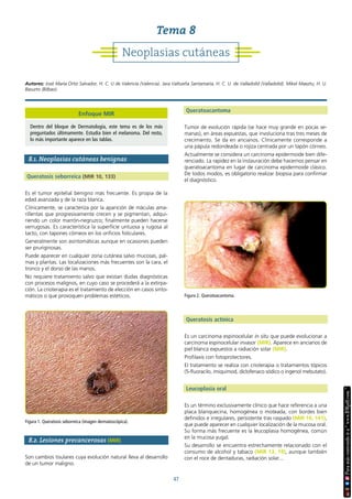 47
8.1. Neoplasias cutáneas benignas
Queratosis seborreica (MIR 10, 133)
Es el tumor epitelial benigno más frecuente. Es propia de la
edad avanzada y de la raza blanca.
Clínicamente, se caracteriza por la aparición de máculas ama-
rillentas que progresivamente crecen y se pigmentan, adqui-
riendo un color marrón-negruzco; finalmente pueden hacerse
verrugosas. Es característica la superficie untuosa y rugosa al
tacto, con tapones córneos en los orificios foliculares.
Generalmente son asintomáticas aunque en ocasiones pueden
ser pruriginosas.
Puede aparecer en cualquier zona cutánea salvo mucosas, pal-
mas y plantas. Las localizaciones más frecuentes son la cara, el
tronco y el dorso de las manos.
No requiere tratamiento salvo que existan dudas diagnósticas
con procesos malignos, en cuyo caso se procederá a la extirpa-
ción. La crioterapia es el tratamiento de elección en casos sinto-
máticos o que provoquen problemas estéticos.
8.2. Lesiones precancerosas (MIR)
Son cambios tisulares cuya evolución natural lleva al desarrollo
de un tumor maligno.
Queratoacantoma
Tumor de evolución rápida (se hace muy grande en pocas se-
manas), en áreas expuestas, que involuciona tras tres meses de
crecimiento. Se da en ancianos. Clínicamente corresponde a
una pápula redondeada o rojiza centrada por un tapón córneo.
Actualmente se considera un carcinoma epidermoide bien dife-
renciado. La rapidez en la instauración debe hacernos pensar en
queratoacantoma en lugar de carcinoma epidermoide clásico.
De todos modos, es obligatorio realizar biopsia para confirmar
el diagnóstico.
Queratosis actínica
Es un carcinoma espinocelular in situ que puede evolucionar a
carcinoma espinocelular invasor (MIR). Aparece en ancianos de
piel blanca expuestos a radiación solar (MIR).
Profilaxis con fotoprotectores.
El tratamiento se realiza con crioterapia o tratamientos tópicos
(5-fluoracilo, imiquimod, diclofenaco sódico o ingenol mebutato).
Leucoplasia oral
Es un término exclusivamente clínico que hace referencia a una
placa blanquecina, homogénea o moteada, con bordes bien
definidos e irregulares, persistente tras raspado (MIR 10, 141),
que puede aparecer en cualquier localización de la mucosa oral.
Su forma más frecuente es la leucoplasia homogénea, común
en la mucosa yugal.
Su desarrollo se encuentra estrechamente relacionado con el
consumo de alcohol y tabaco (MIR 13, 19), aunque también
con el roce de dentaduras, radiación solar...
Figura 1. Queratosis seborreica (imagen dermatoscópica).
Figura 2. Queratoacantoma.
Neoplasias cutáneas
Tema 8
Autores: José María Ortiz Salvador, H. C. U de Valencia (Valencia). Jara Valtueña Santamaría, H. C. U. de Valladolid (Valladolid). Mikel Maeztu, H. U.
Basurto (Bilbao).
Enfoque MIR
Dentro del bloque de Dermatología, este tema es de los más
preguntados últimamente. Estudia bien el melanoma. Del resto,
lo más importante aparece en las tablas.
 