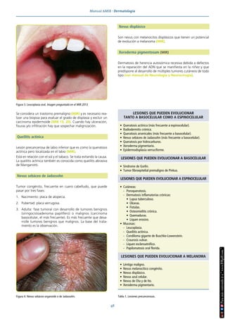 Manual AMIR · Dermatología
48
Se considera un trastorno premaligno (MIR) y es necesario rea-
lizar una biopsia para evaluar el grado de displasia y excluir un
carcinoma epidermoide (MIR 13, 20). Cuando hay ulceración,
fisuras y/o infiltración hay que sospechar malignización.
Queilitis actínica
Lesión precancerosa de labio inferior que es como la queratosis
actínica pero localizada en el labio (MIR).
Está en relación con el sol y el tabaco. Se trata evitando la causa.
La queilitis actínica también es conocida como queilitis abrasiva
de Manganotti.
Nevus sebáceo de Jadassohn
Tumor congénito, frecuente en cuero cabelludo, que puede
pasar por tres fases:
1. Nacimiento: placa de alopecia.
2. Pubertad: placa verrugosa.
3. Adulta: fase tumoral con desarrollo de tumores benignos
(siringocistoadenoma papilífero) o malignos (carcinoma
basocelular, el más frecuente). Es más frecuente que desa-
rrolle tumores benignos que malignos. La base del trata-
miento es la observación.
Nevus displásico
Son nevus con melanocitos displásicos que tienen un potencial
de evolución a melanoma (MIR).
Xeroderma pigmentosum (MIR)
Dermatosis de herencia autosómica recesiva debida a defectos
en la reparación del ADN que se manifiesta en la niñez y que
predispone al desarrollo de múltiples tumores cutáneos de todo
tipo (ver manual de Neurología y Neurocirugía).
Figura 4. Nevus sebáceo organoide o de Jadassohn.
Figura 3. Leucoplasia oral. Imagen preguntada en el MIR 2013.
Tabla 1. Lesiones precancerosas.
LESIONES QUE PUEDEN EVOLUCIONAR
TANTO A BASOCELULAR COMO A ESPINOCELULAR
• Queratosis actínica (más frecuente a espinocelular).
• Radiodermitis crónica.
• Queratosis arsenicales (más frecuente a basocelular).
• Nevus sebáceo de Jadassohn (más frecuente a basocelular).
• Queratosis por hidrocarburos.
• Xeroderma pigmentario.
• Epidermodisplasia verruciforme.
LESIONES QUE PUEDEN EVOLUCIONAR A BASOCELULAR
• Síndrome de Gorlin.
• Tumor fibroepitelial premaligno de Pinkus.
LESIONES QUE PUEDEN EVOLUCIONAR A ESPINOCELULAR
• Cutáneas:
- Poroqueratosis.
- Dermatosis inflamatorias crónicas:
• Lupus tuberculoso.
• Úlceras.
• Fístulas.
• Osteomielitis crónica.
• Quemaduras.
• Liquen erosivo.
• Mucosas:
- Leucoplasia.
- Queilitis actínica.
- Condiloma gigante de Buschke-Lowenstein.
- Craurosis vulvar.
- Liquen escleroatrófico.
- Papilomatosis oral florida.
LESIONES QUE PUEDEN EVOLUCIONAR A MELANOMA
• Léntigo maligno.
• Nevus melanocítico congénito.
• Nevus displásico.
• Nevus azul celular.
• Nevus de Ota y de Ito.
• Xeroderma pigmentario.
 