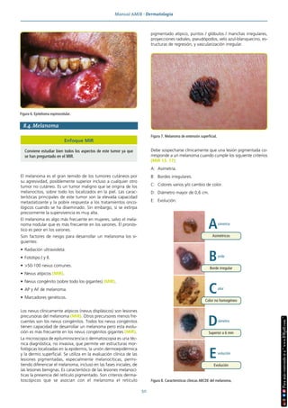 Manual AMIR · Dermatología
50
8.4. Melanoma
El melanoma es el gran temido de los tumores cutáneos por
su agresividad, posiblemente superior incluso a cualquier otro
tumor no cutáneo. Es un tumor maligno que se origina de los
melanocitos, sobre todo los localizados en la piel. Las carac-
terísticas principales de este tumor son la elevada capacidad
metastatizante y la pobre respuesta a los tratamientos onco-
lógicos cuando se ha diseminado. Sin embargo, si se extirpa
precozmente la supervivencia es muy alta.
El melanoma es algo más frecuente en mujeres, salvo el mela-
noma nodular que es más frecuente en los varones. El pronós-
tico es peor en los varones.
Son factores de riesgo para desarrollar un melanoma los si-
guientes:
• Radiación ultravioleta.
• Fototipo I y II.
• >50-100 nevus comunes.
• Nevus atípicos (MIR).
• Nevus congénito (sobre todo los gigantes) (MIR).
• AP y AF de melanoma.
• Marcadores genéticos.
Los nevus clínicamente atípicos (nevus displásicos) son lesiones
precursoras del melanoma (MIR). Otros precursores menos fre-
cuentes son los nevus congénitos. Todos los nevus congénitos
tienen capacidad de desarrollar un melanoma pero esta evolu-
ción es más frecuente en los nevus congénitos gigantes (MIR).
La microscopia de epiluminiscencia o dermatoscopia es una téc-
nica diagnóstica, no invasiva, que permite ver estructuras mor-
fológicas localizadas en la epidermis, la unión dermoepidérmica
y la dermis superficial. Se utiliza en la evaluación clínica de las
lesiones pigmentadas, especialmente melanocíticas, permi-
tiendo diferenciar el melanoma, incluso en las fases iniciales, de
las lesiones benignas. Es característico de las lesiones melanocí-
ticas la presencia del retículo pigmentado. Son criterios derma-
toscópicos que se asocian con el melanoma el retículo
pigmentado atípico, puntos / glóbulos / manchas irregulares,
proyecciones radiales, pseudópodos, velo azul-blanquecino, es-
tructuras de regresión, y vascularización irregular.
Debe sospecharse clínicamente que una lesión pigmentada co-
rresponde a un melanoma cuando cumple los siguiente criterios
(MIR 13, 17):
A: Asimetría.
B: Bordes irregulares.
C: Colores varios y/o cambio de color.
D: Diámetro mayor de 0,6 cm.
E: Evolución.
Enfoque MIR
Conviene estudiar bien todos los aspectos de este tumor ya que
se han preguntado en el MIR.
Figura 7. Melanoma de extensión superficial.
A
Asimétricos
simetría
B
Borde irregular
orde
C
Color no homogéneo
olor
D
Superior a 6 mm
iámetro
E
Evolución
volución
Figura 8. Características clínicas ABCDE del melanoma.
Figura 6. Epitelioma espinocelular.
 