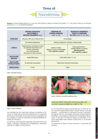 67
Las toxicodermias son reacciones cutáneas secundarias a fár-
macos. En todas ellas la base del tratamiento es la suspensión
del fármaco responsable. El principal mecanismo patogénico es
inmunológico, a través de reacciones de hipersensibilidad me-
diadas por linfocitos T.
Los fármacos más frecuentes implicados son la penicilina y de-
rivados, sulfamidas, cefalosporinas, antiepilépticos, alopurinol,
sales de oro, AINES y nitrofurantoína.
Síndrome DRESS (Drug Rash with Eosinophilia and
Systemic Symptoms) (MIR 20, 6; MIR 19, 74)
Es una toxicodermia grave caracterizada por la triada de fie-
bre, exantema (típico edema facial, máculas difusas, vesículas,
ampollas…, normalmente sin afectación mucosa), y afectación
de órganos internos: adenopatías, afectación visceral (hepática,
nefrológica, neumológica) y alteraciones hematológicas (leuco-
citosis, a menudo con linfocitos atípicos y eosinofilia). El fár-
maco responsable suele haberse iniciado entre 2 y 8 semanas
previamente.
El tratamiento se basa en retirar el fármaco + corticoides 6-8
semanas.
Figura 1. Eritema multiforme.
Toxicodermias
Tema 16
Autores: Ana María Delgado Márquez, H. U. Rey Juan Carlos (Móstoles, Madrid). José María Ortiz Salvador, H. C. U de Valencia (Valencia). Jara Valtueña
Santamaría, H. C. U. de Valladolid (Valladolid).
Figura 2. Pacientes con necrólisis epidérmica tóxica.
Tabla 1. Dermatitis reactivas.
ERITEMA EXUDATIVO
MULTIFORME O
ERITEMA POLIMORFO (MIR)
SÍNDROME DE
STEVENS-JOHNSON
(MIR 16, 30)
NECRÓLISIS EPIDÉRMICA
TÓXICA O SÍNDROME
DE LYELL (MIR 20, 49; MIR)
ETIOLOGÍA Infecciosa: 50% tras un brote de VHS Farmacológico
CLÍNICA
No síntomas prodrómicos Síntomas prodrómicos: síntomas constitucionales
Erupción brusca con lesiones en diana
de predominio típicamente acral
Lesiones monomorfas
en un mismo paciente
Infrecuente en niños y ancianos
Lesiones en diana
atípicas en tronco y extremidades
<10% superficie corporal
Eritema generalizado →
ampollas flácidas y erosiones:
Nikolsky positivo
≥30% superficie corporal
AFECTACIÓN
MUCOSA
Puede (EEM mayor) Sí (90-100%) (MIR 17, 67)
AFECTACIÓN
EXTRACUTÁNEA
No afectación extracutánea Puede existir afectación extracutánea
MORTALIDAD 5-15% 5-50%
 