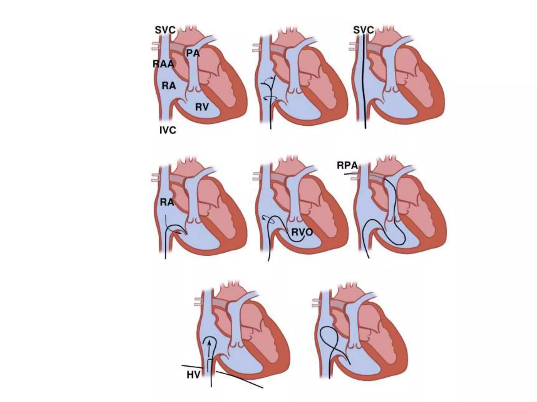 12 Right Heart Catheterization Pros Cons Calculations PPT 12-right-heart-catheterization-pros-cons-calculations-ppt