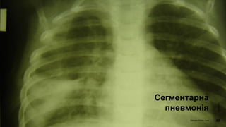 Сегментарна
пневмонія
4/18/2023
Sample Footer Text 40
 