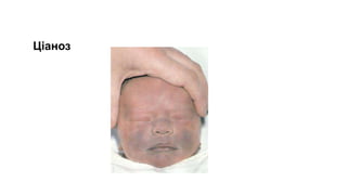 Ціаноз
 