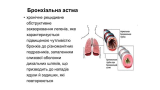 Бронхіальна астма
• хронічне рецидивне
обструктивне
захворювання легенів, яке
характеризується
підвищеною чутливістю
бронхів до різноманітних
подразників, запаленням
слизової оболонки
дихальних шляхів, що
призводить до нападів
ядухи й задишки, які
повторюються
 