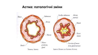 Астма: патологічні зміни
 