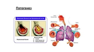 Патогенез
 