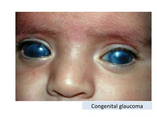 12.pp glaucoma.ppt