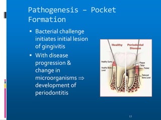 Pathogenesis – Pocket
Formation
 Bacterial challenge
initiates initial lesion
of gingivitis
 With disease
progression &
change in
microorganisms 
development of
periodontitis
13
 