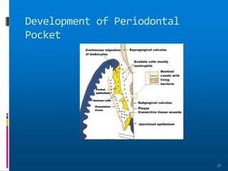 Development of Periodontal
Pocket
17
 