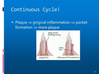 Continuous Cycle!
 Plaque  gingival inflammation  pocket
formation  more plaque
18
 