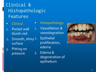 Clinical &
Histopathologic
Features
 Clinical :
1. Pocket wall
bluish-red
2. Smooth, shiny
surface
3. Pitting on
pressure
 Histopathology:
1. Vasodilation &
vasostagnation
2. Epithelial
proliferation,
edema
3. Edema &
degeneration of
epithelium
22
 