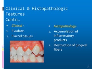Clinical & Histopathologic
Features
Contn…
 Clinical :
1. Exudate
2. Flaccid tissues
 Histopathology:
1. Accumulation of
inflammatory
products
2. Destruction of gingival
fibers
24
 