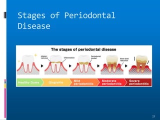 Stages of Periodontal
Disease
25
 