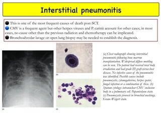 Interstitial pneumonitis
This is one of the most frequent causes of death post-SCT.
🔵
CMV is a frequent agent but other herpes viruses and P. carinii account for other cases; in most
cases, no cause other than the previous radiation and chemotherapy can be implicated.
Bronchoalveolar lavage or open lung biopsy may be needed to establish the diagnosis.
(a) Chest radiograph showing interstitial
pneumonitis following bone marrow
transplantation. Widespread diffuse mottling
can be seen. The patient had received total body
irradiation and had grade III graft-versus-host
disease. No infective cause of the pneumonitis
was identified. Possible causes include
pneumocystis, cytomegalovirus, herpes zoster,
fungal infection or a combination of these. (b)
Sputum cytology: intranuclear CMV inclusion
body in a pulmonary cell. Papanicolaou stain.
(c) Pneumocystis jirovecii in bronchial washings,
Gram–Weigert stain.
 