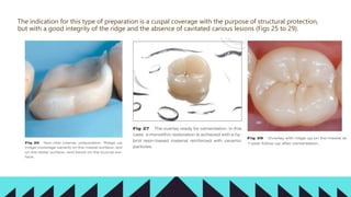 Cuspal Protection PARTIAL BONDED RESTORATIONS AND IT’S ADHESION.pptx