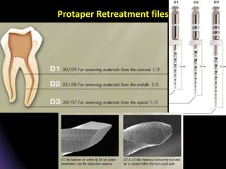 Protaper Retreatment files
 