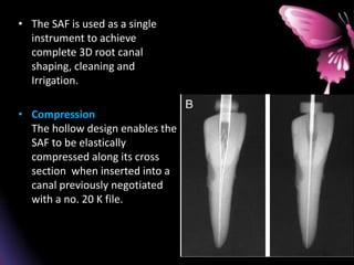 • The SAF is used as a single
instrument to achieve
complete 3D root canal
shaping, cleaning and
Irrigation.
• Compression
The hollow design enables the
SAF to be elastically
compressed along its cross
section when inserted into a
canal previously negotiated
with a no. 20 K file.
 