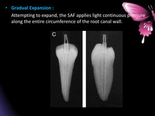• Gradual Expansion :
Attempting to expand, the SAF applies light continuous pressure
along the entire circumference of the root canal wall.
 