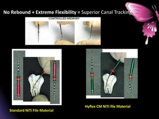 No Rebound + Extreme Flexibility = Superior Canal Tracking58
No Rebound + Extreme Flexibility = Superior Canal Tracking
Standard NiTi File Material
Hyflex CM NiTi file Material
 
