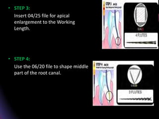 • STEP 3:
Insert 04/25 file for apical
enlargement to the Working
Length.
• STEP 4:
Use the 06/20 file to shape middle
part of the root canal.
 