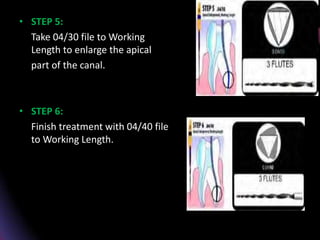 • STEP 5:
Take 04/30 file to Working
Length to enlarge the apical
part of the canal.
• STEP 6:
Finish treatment with 04/40 file
to Working Length.
 