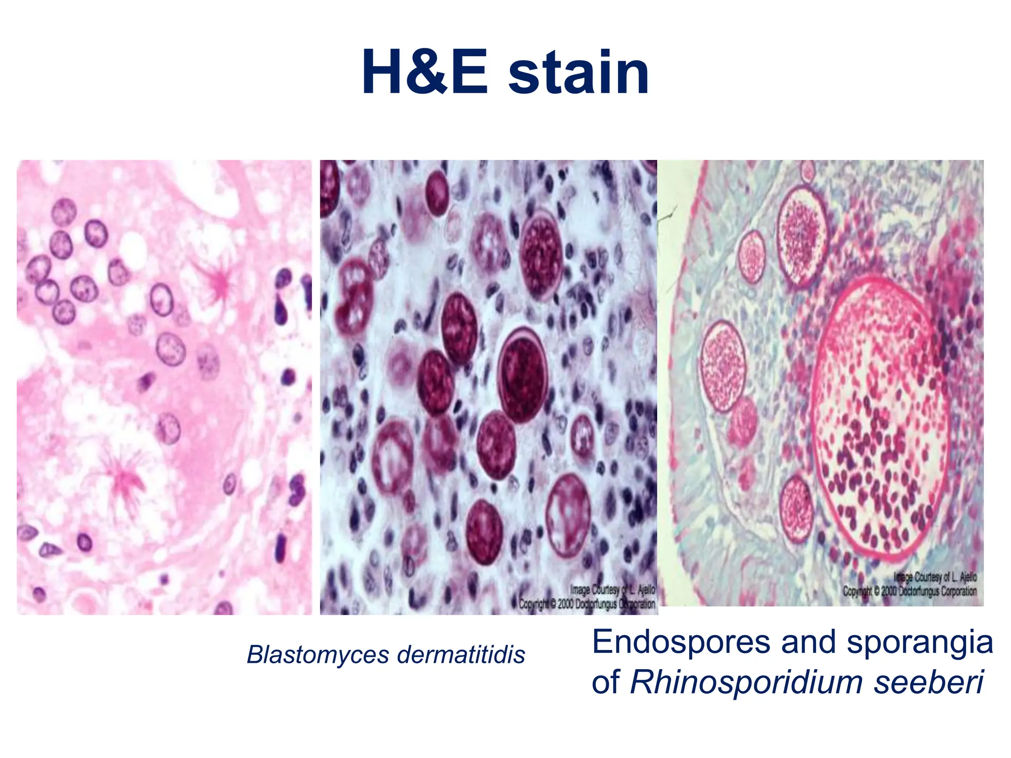 H&E stain
Endospores and sporangia
of Rhinosporidium seeberi
Blastomyces dermatitidis
 