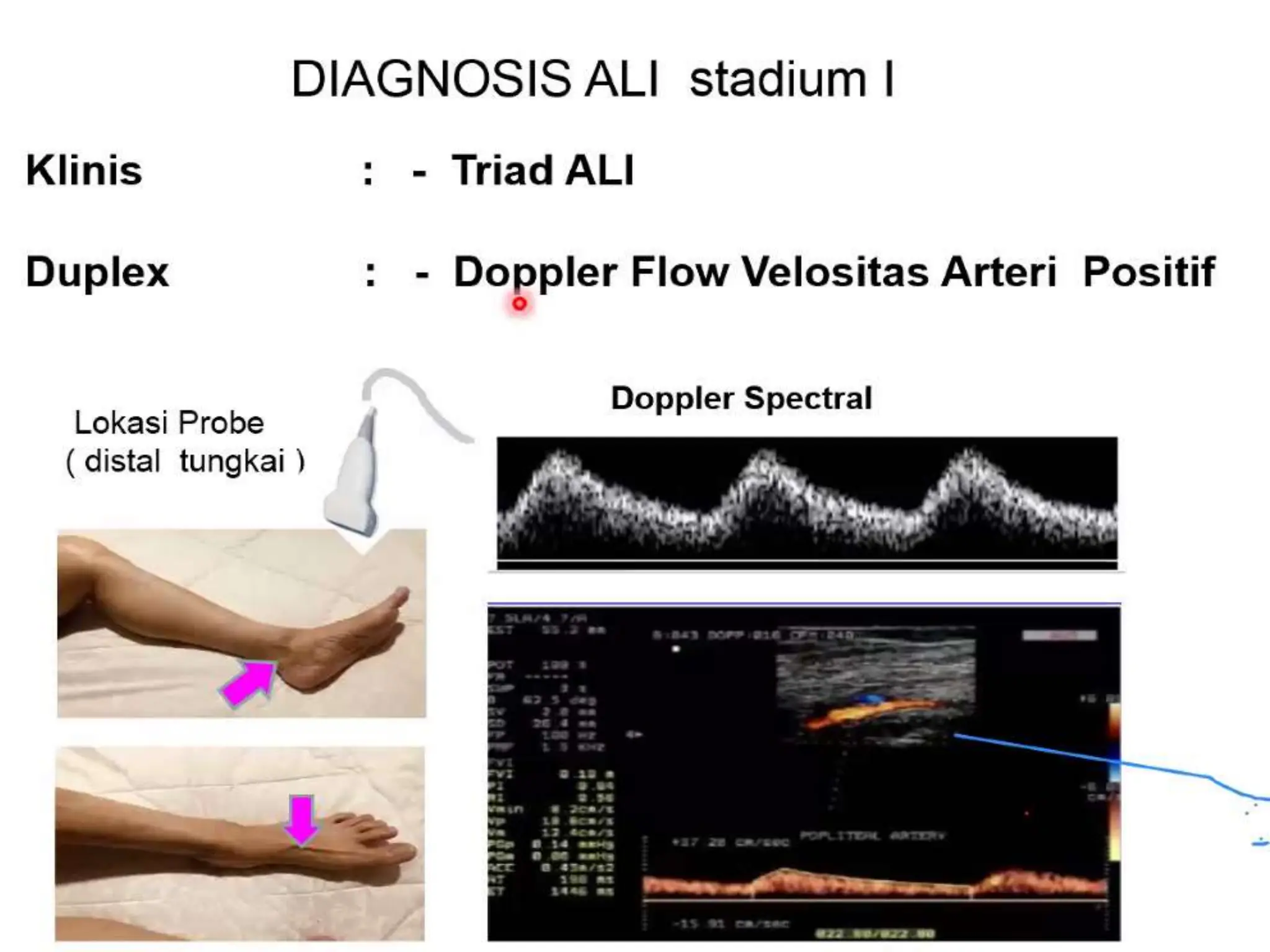 DIAGNOSE AND MANAGEMENT OF ACUTE LIMB ISCHEMIA.pptx