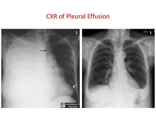 CXR of Pleural Effusion
L L
 