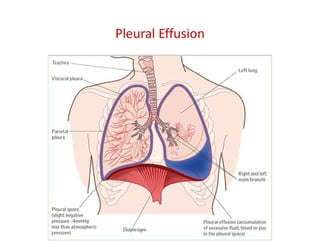 Pleural Effusion
 