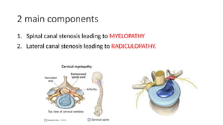 2 main components
1. Spinal canal stenosis leading to MYELOPATHY
2. Lateral canal stenosis leading to RADICULOPATHY.
 