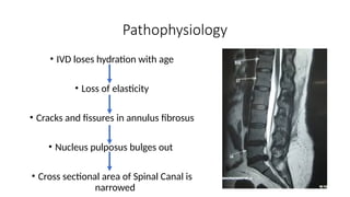 Pathophysiology
• IVD loses hydration with age
• Loss of elasticity
• Cracks and fissures in annulus fibrosus
• Nucleus pulposus bulges out
• Cross sectional area of Spinal Canal is
narrowed
 