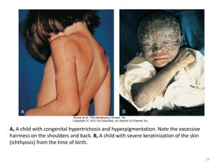 A, A child with congenital hypertrichosis and hyperpigmentation. Note the excessive
hairiness on the shoulders and back. B, A child with severe keratinization of the skin
(ichthyosis) from the time of birth.
24
 