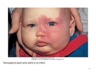 Hemangioma (port-wine stain) in an infant.
28
 