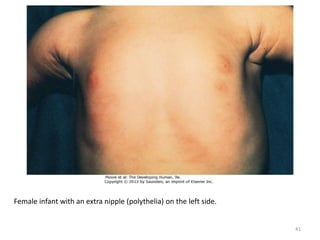 Female infant with an extra nipple (polythelia) on the left side.
41
 