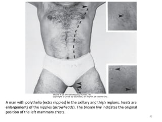 A man with polythelia (extra nipples) in the axillary and thigh regions. Insets are
enlargements of the nipples (arrowheads). The broken line indicates the original
position of the left mammary crests.
42
 