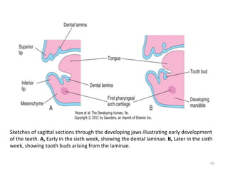 Sketches of sagittal sections through the developing jaws illustrating early development
of the teeth. A, Early in the sixth week, showing the dental laminae. B, Later in the sixth
week, showing tooth buds arising from the laminae.
63
 