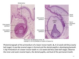 Photomicrograph of the primordium of a lower incisor tooth. A, A 12-week-old fetus (early
bell stage). A cap-like enamel organ is formed and the dental papilla is developing beneath
it. B, Primordium of a lower incisor tooth in a 15-week-old fetus (late bell stage). Observe
the inner and outer enamel layers, the dental papilla, and bud of the permanent tooth.
69
 